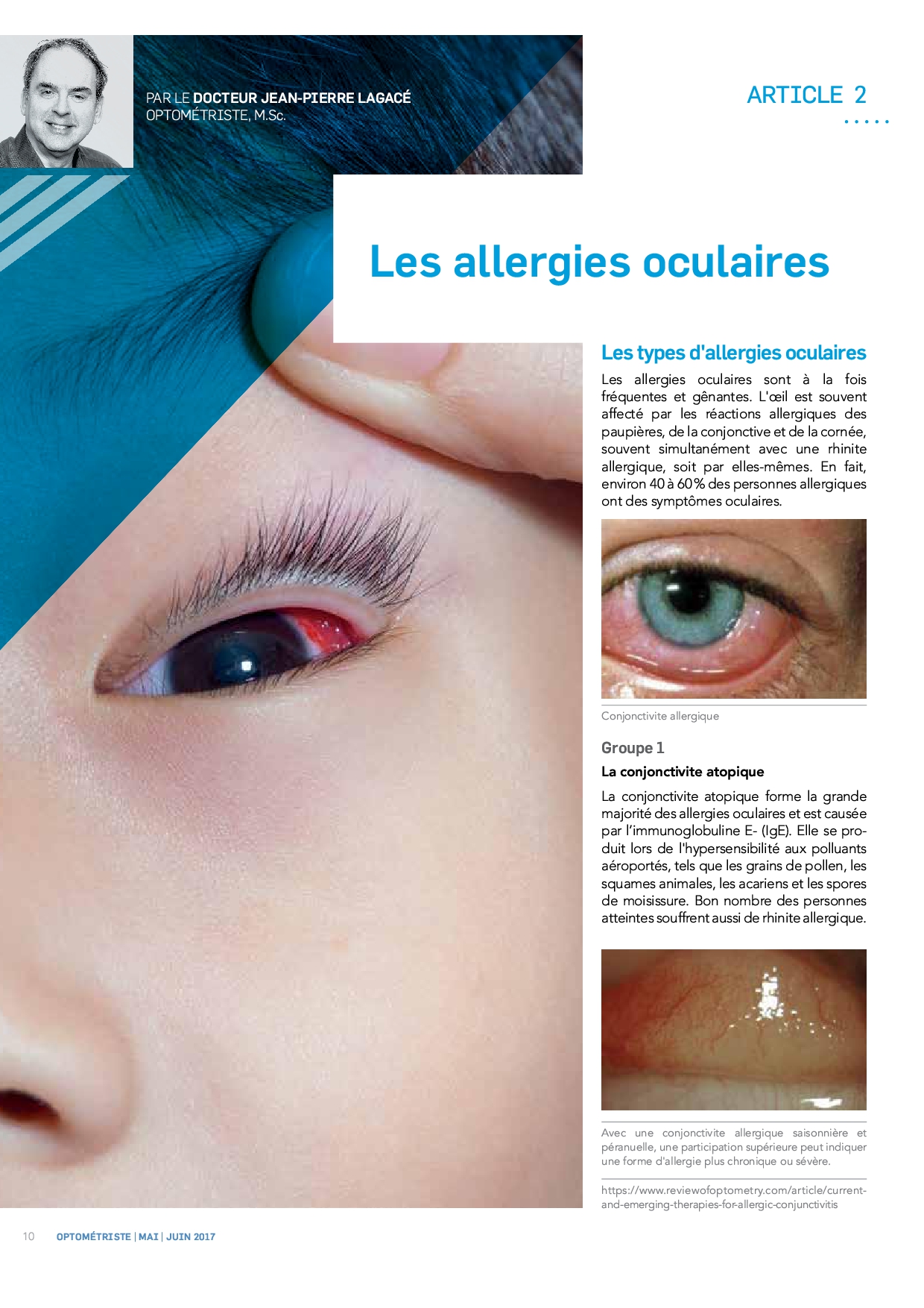 Les allergies oculaires